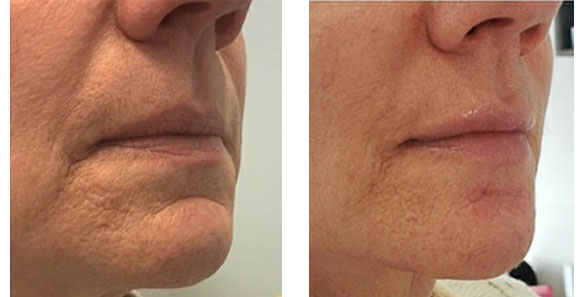 filler-before-after-1