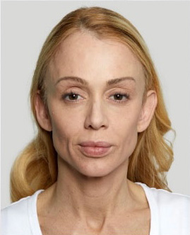 sculptra-aesthetic-before