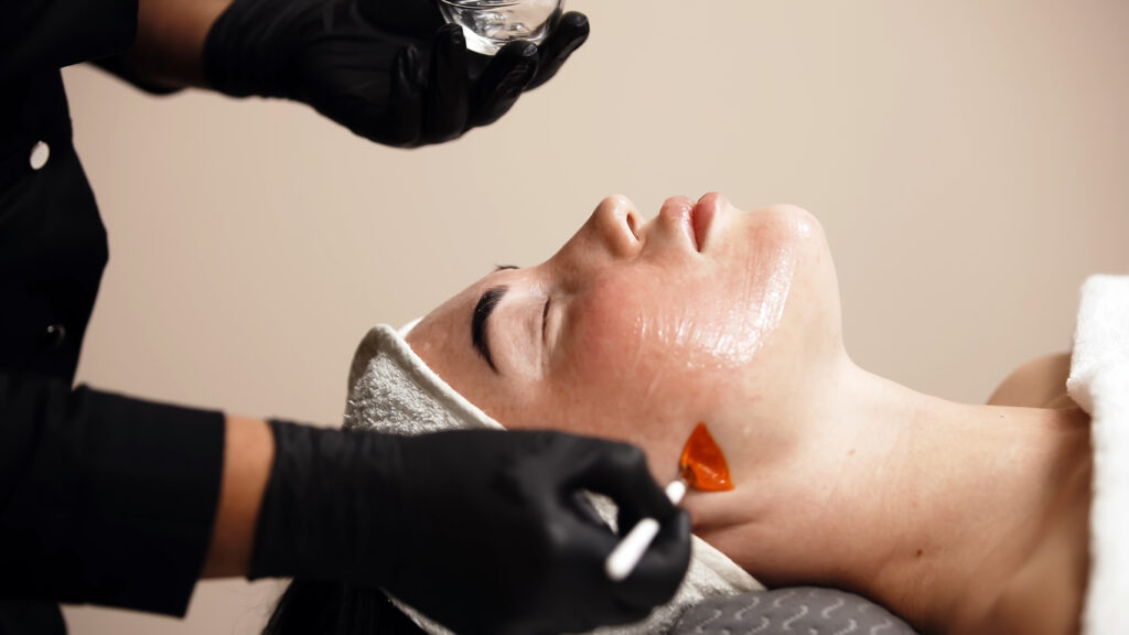 Chemical Peel at Jersey Shore Aesthetics